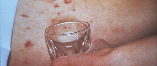 Менингит. Симптомы, диагностика, лечение, профилактика